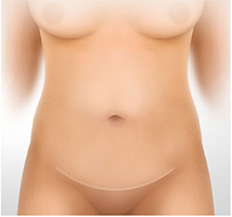 rofit-after-abdominal-mini-tummy-tuck-Tunisia